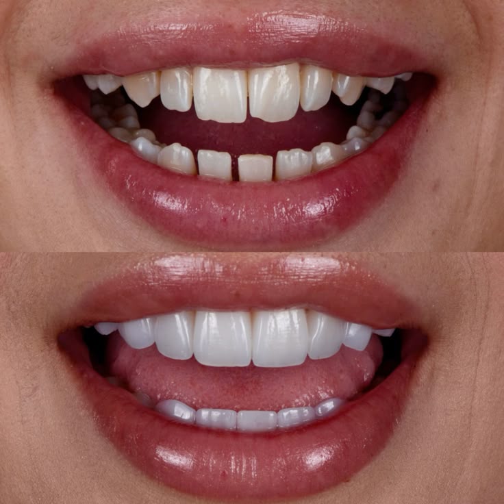 Dreaming of that Hollywood smile WITHOUT shaving…