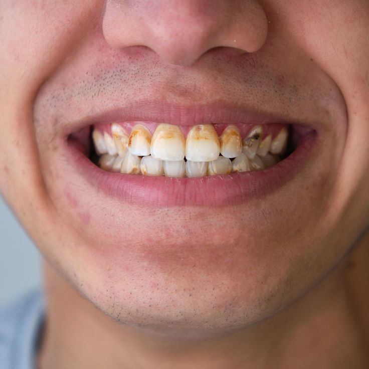 El #sarronegro es una sustancia compuesta por…